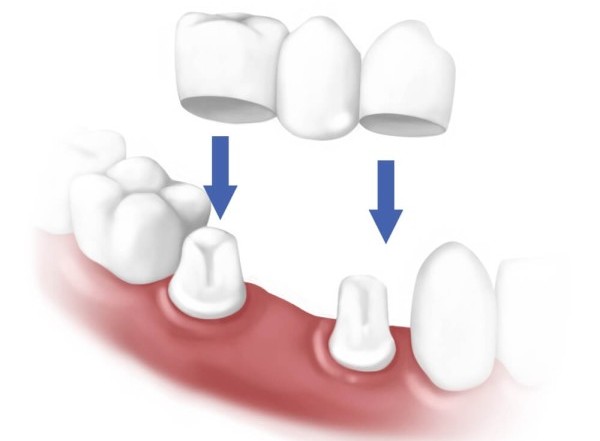 Мостовидный протез на обточенных зубах